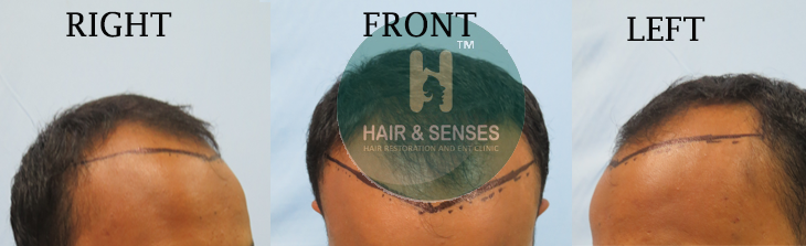 Hairline Designing 2500